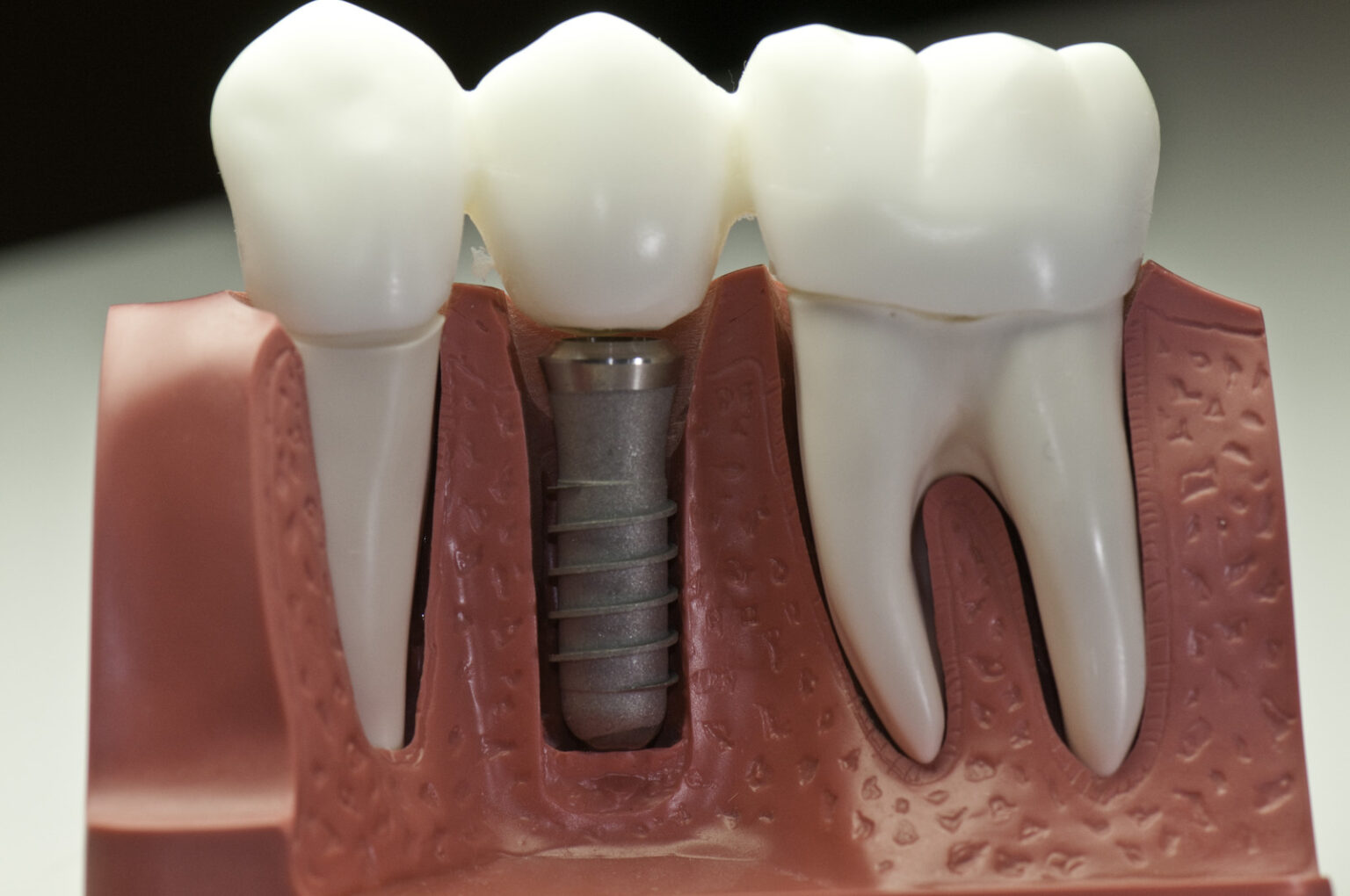 dental implants near you