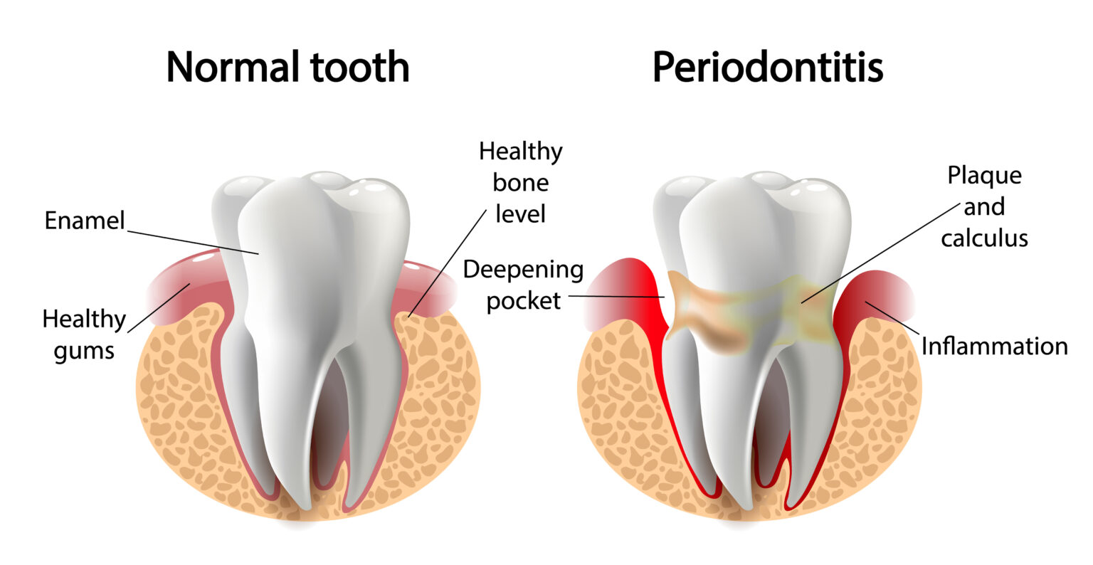 periodontal treatment in rutland