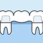 things to know about dental bridges