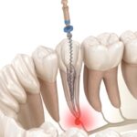 signs you might need a root canal in kelowna
